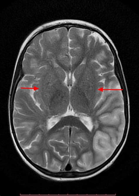 moyamo|moyamoya disease life expectancy.